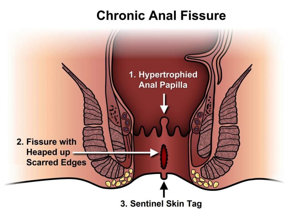 Chronic anal fissure medical diagram explained by Dr. Sanjiv Warkhede, Best Piles Doctor in Jabalpur