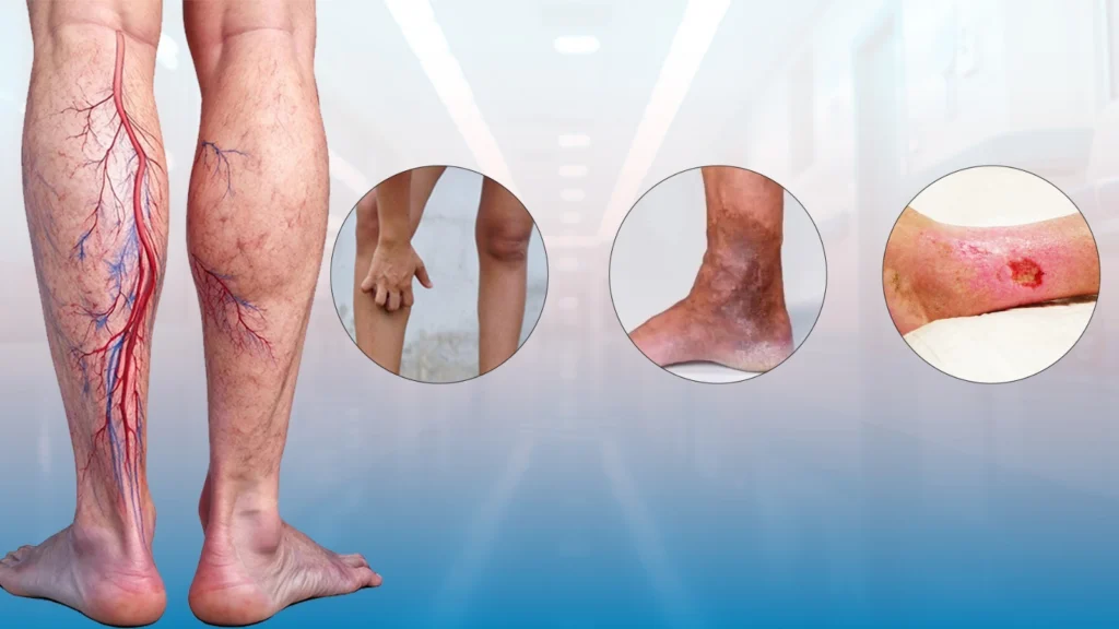 Varicose veins symptoms in legs treated by Dr. Sanjiv Warkhede, Best Piles Doctor in Jabalpur