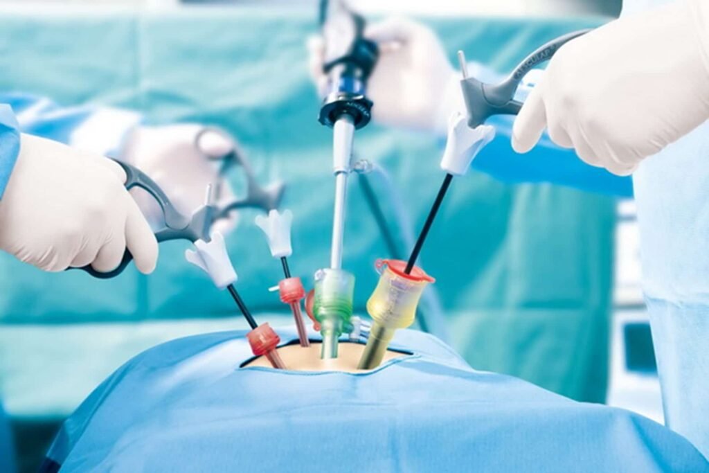 Laparoscopic surgery procedure performed by Dr. Sanjiv Warkhede, Best Piles Doctor in Jabalpur