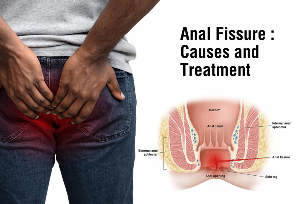 Anal fissure causes and treatment explained by Dr. Sanjiv Warkhede, Best Piles Doctor in Jabalpur