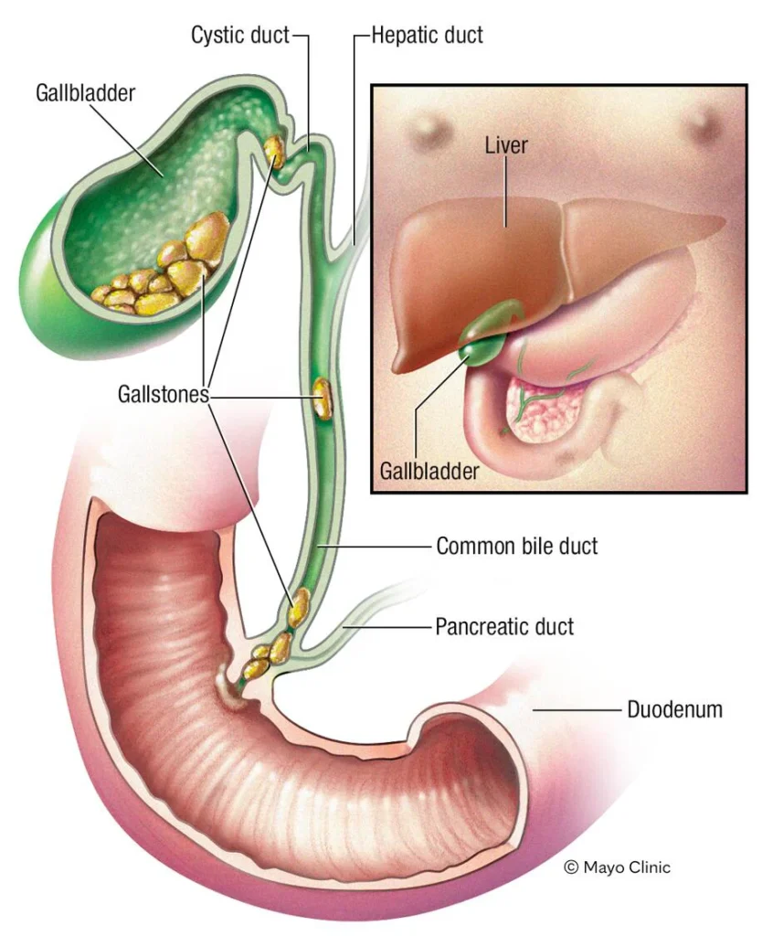 Gallstones medical diagram explained by Dr. Sanjiv Warkhede, Best Piles Doctor in Jabalpur