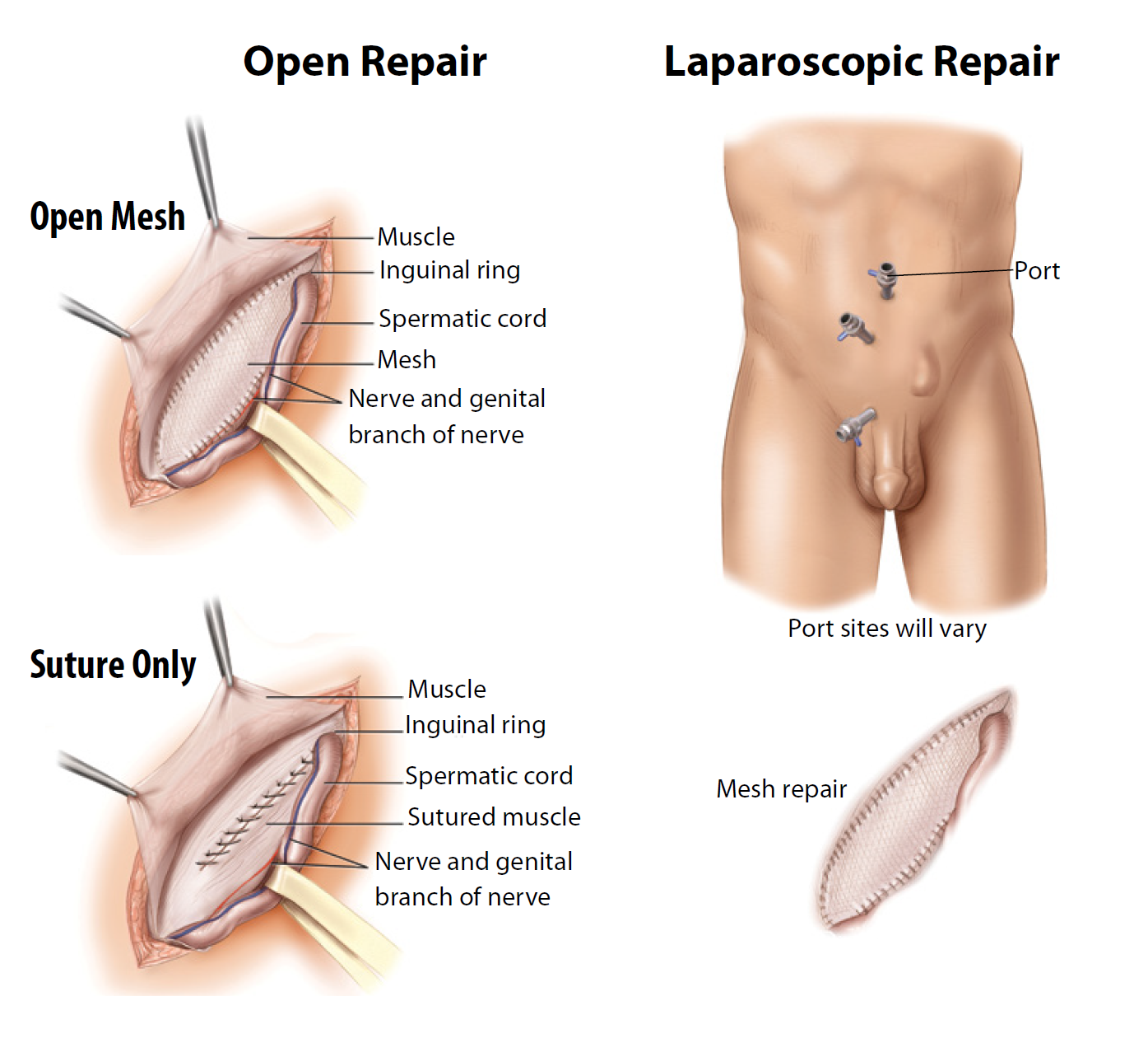 Hernia surgery open repair and laparoscopic repair explained by Dr. Sanjiv Warkhede, Best Piles Doctor in Jabalpur