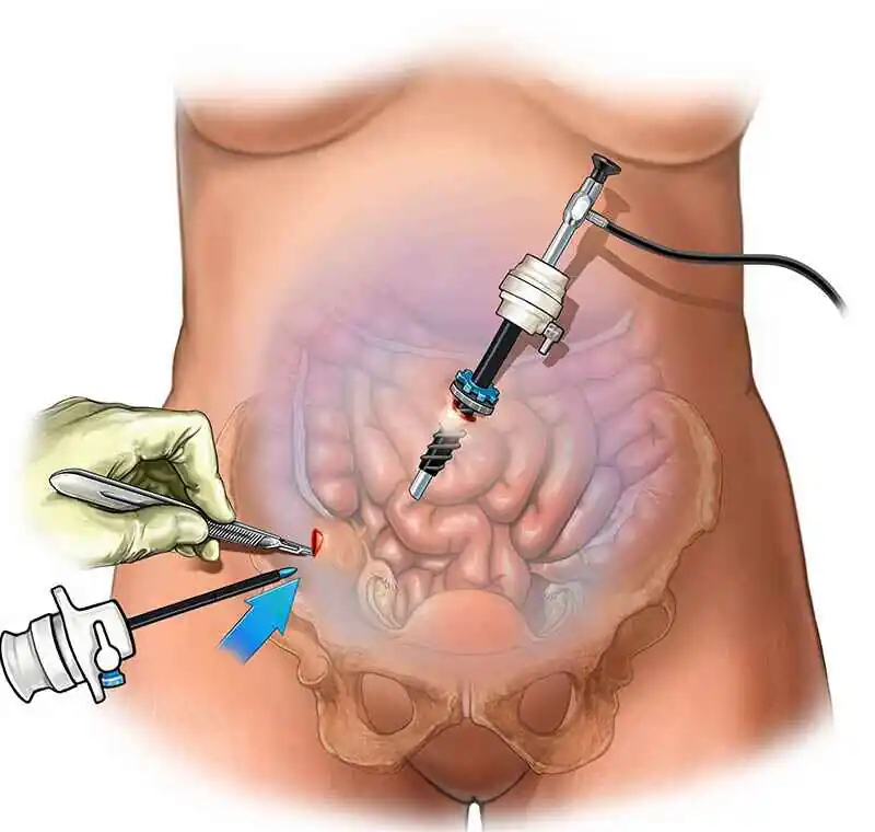 Diagnostic laparoscopy procedure explained by Dr. Sanjiv Warkhede, Best Piles Doctor in Jabalpur