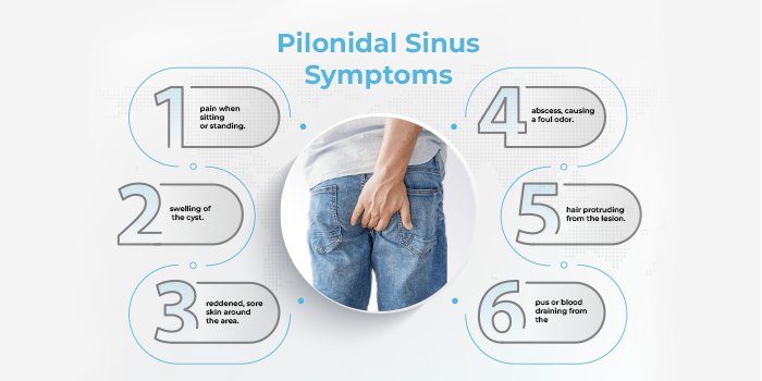 Common symptoms of pilonidal sinus explained by Dr. Sanjiv Warkhede, Best Piles Doctor in Jabalpur