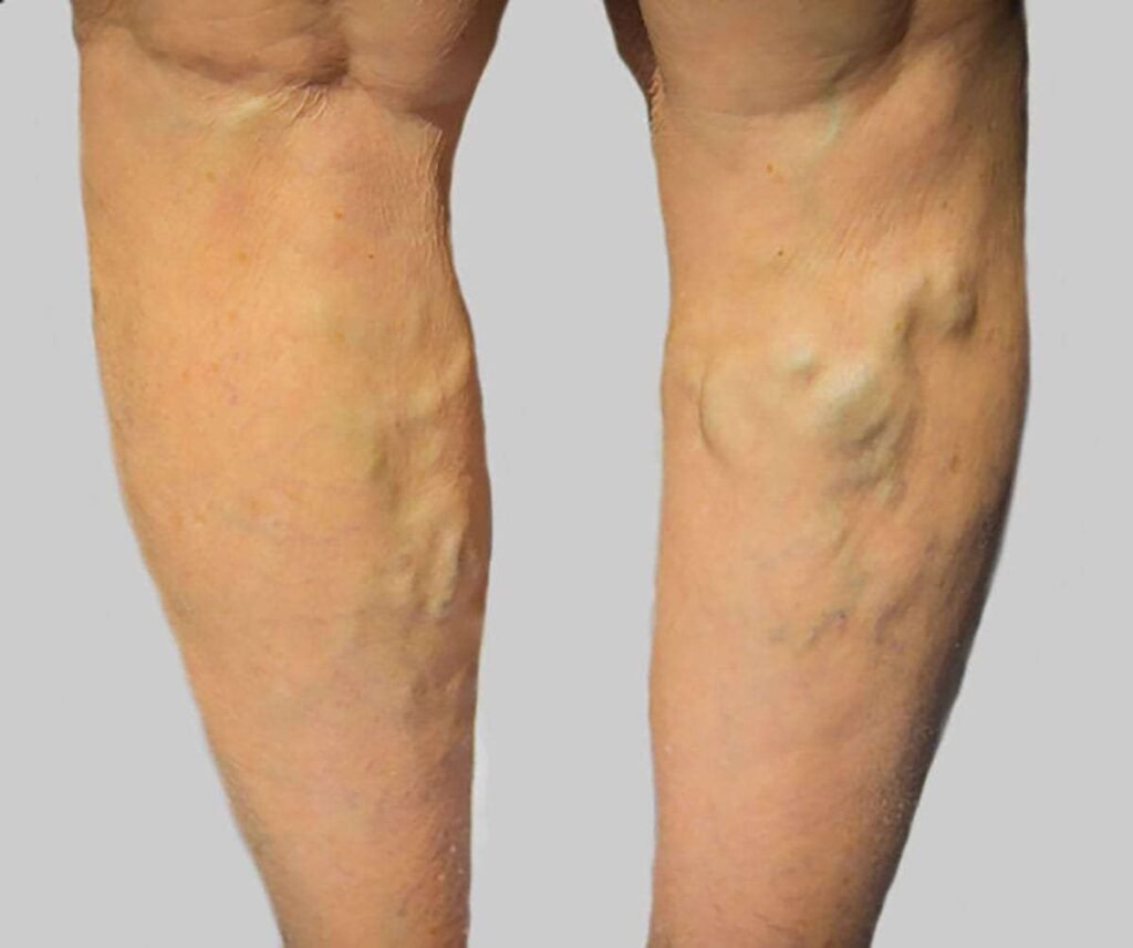 Varicose veins in legs treated by Dr. Sanjiv Warkhede, Best Piles Doctor in Jabalpur