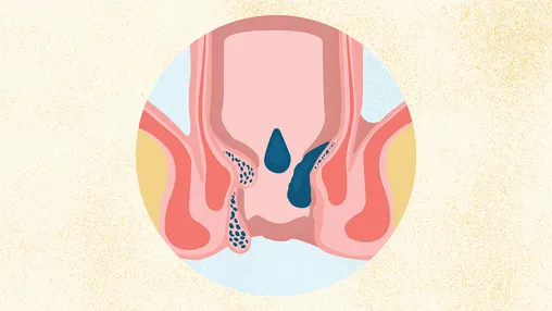 Hemorrhoids treatment illustration by Dr. Sanjiv Warkhede, Best Piles Doctor in Jabalpur